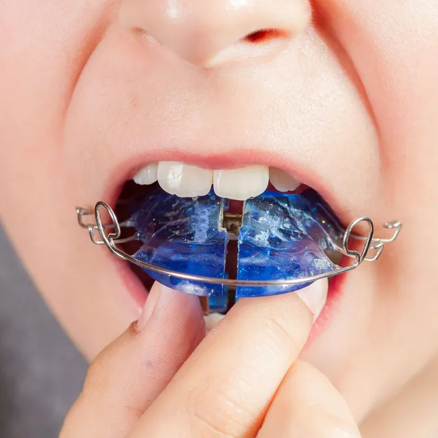 Interceptive Orthodontics